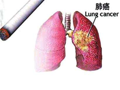 年年拍胸片为何不能发现早期肺癌?哪些是肺癌高危人群?要怎么办