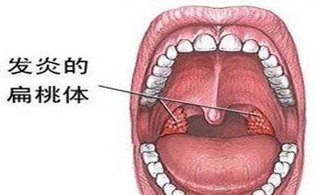 成年以后,扁桃体逐渐萎缩,比起成人免疫系统中的诸多免疫器官(骨髓