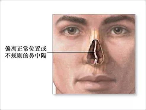 说鼻中隔处于鼻子的正中间,但是得了这种病的患者的鼻中隔往往会弯曲