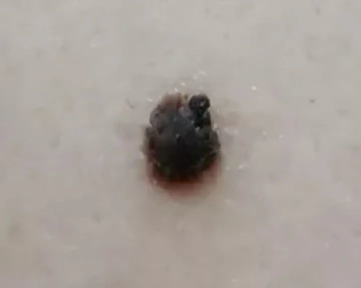 癌变的痣,这25种黑痣需警惕,转给所有人!