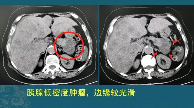 腹胀8天,她查出2个肺癌,100多个肝转移瘤,防癌该怎样