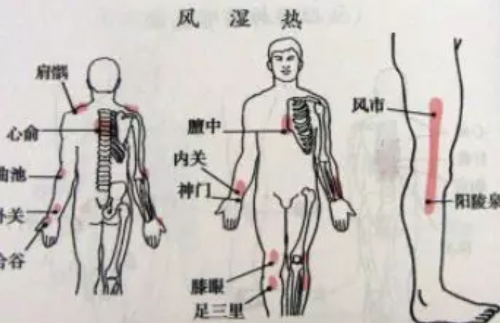 风湿热与风湿病不要傻傻分不清