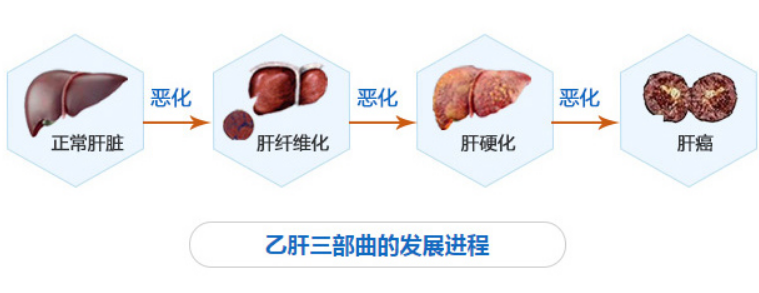 乙肝患者一定会发展为肝硬化和肝癌吗