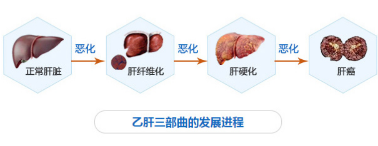 乙肝患者一定会发展为肝硬化和肝癌吗?