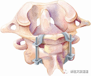 一文了解寰枢椎后路固定技术的前世今生