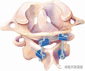 一文了解:寰枢椎后路固定技术的"前世今生"