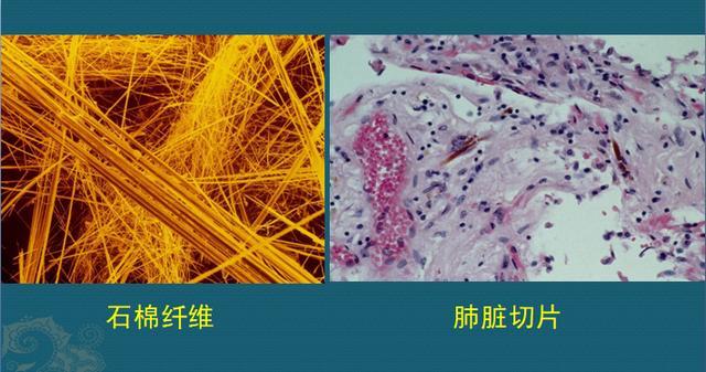 石棉纤维有致癌性,吸入早期无症状,10年后可发生石棉肺