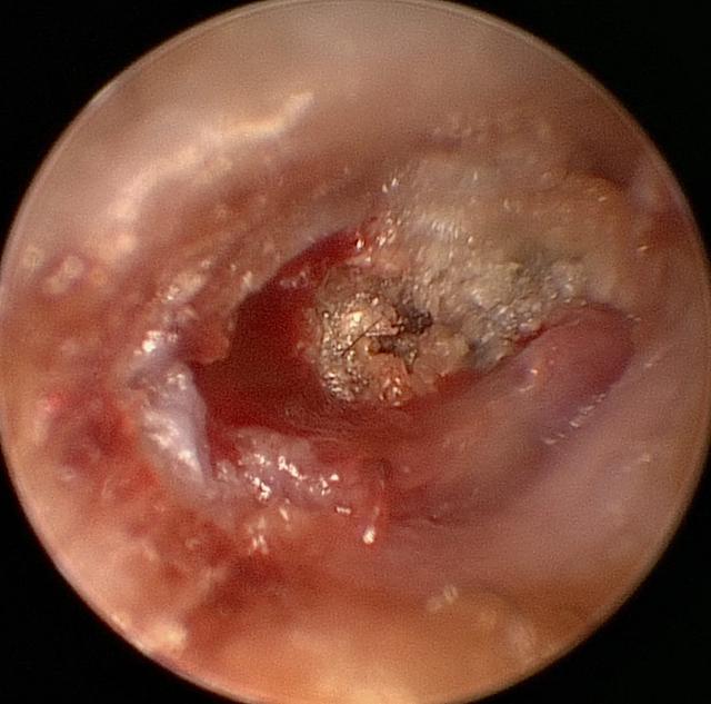 耳朵痛以为是中耳炎,谁知竟是胆脂瘤|化脓性中耳炎|胆脂瘤|外耳道