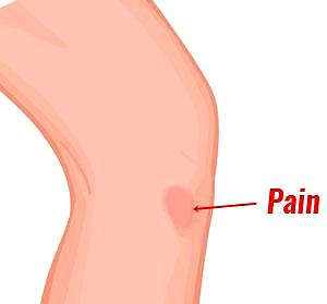 运动后膝盖内侧疼痛,有三个常见病因,该如何应对,医生