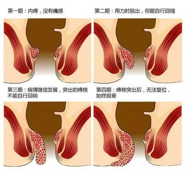 "肛"湖问道 痔疮分型_腾讯新闻