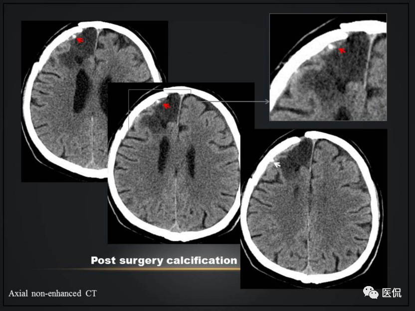 干货!颅脑 ct 钙化模式对疾病鉴别诊断意义