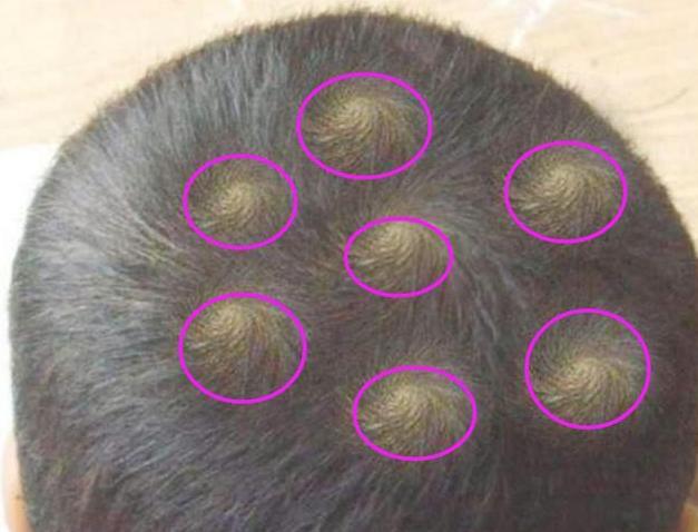 孩子头上的"旋"的个数,暗示娃智商高低?家长们早知早受益