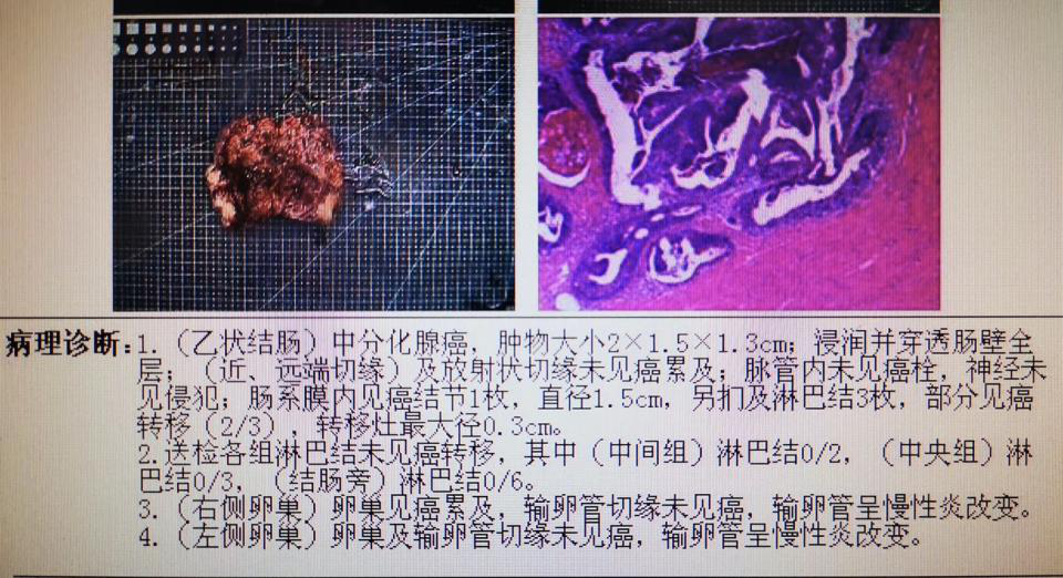 陈功教授病例分享:结直肠癌同时性肝转移诊疗新理念:肝脏优先