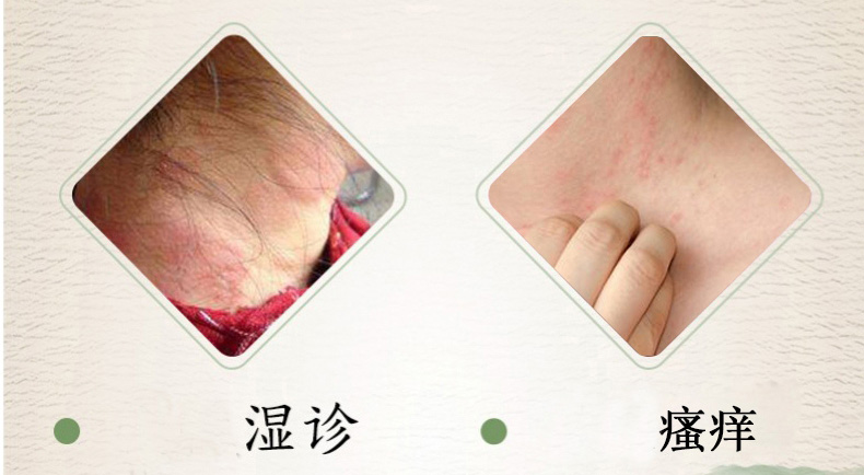 除了普通的皮肤瘙痒症,在夏季,湿疹也是引发皮肤瘙痒的重要疾病.