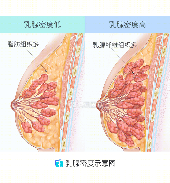 女性乳房,暗藏肿瘤,这类人群得乳腺癌风险,高出常人5倍!