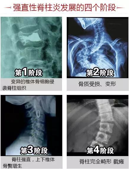 被强直性脊柱炎痛苦折磨?强直可致残 危害不容小觑