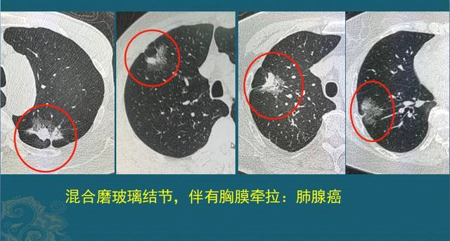 肺结节是怎么长出来的?医生用ct片详解,有2种可能是肺癌