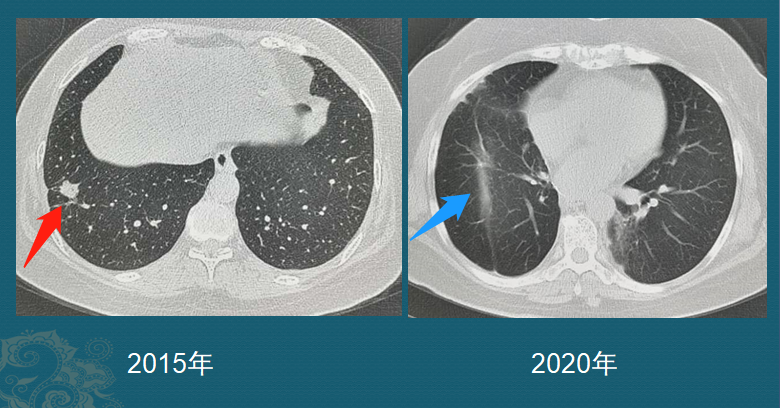 肺结节是怎么长出来的?医生用ct片详解,有2种可能是肺癌