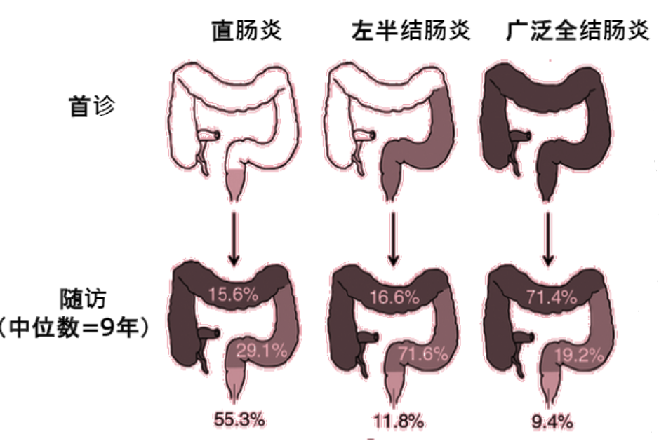 溃疡性结肠炎的治疗,生物制剂的时机应怎样正确开启?_腾讯新闻