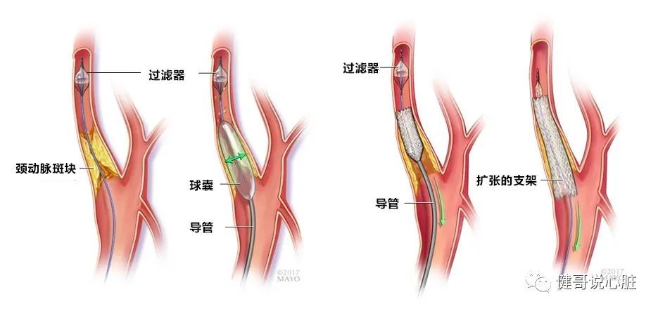 颈动脉支架成形术也是治疗颈动脉狭窄的手术方法之一; 颈动脉狭窄处