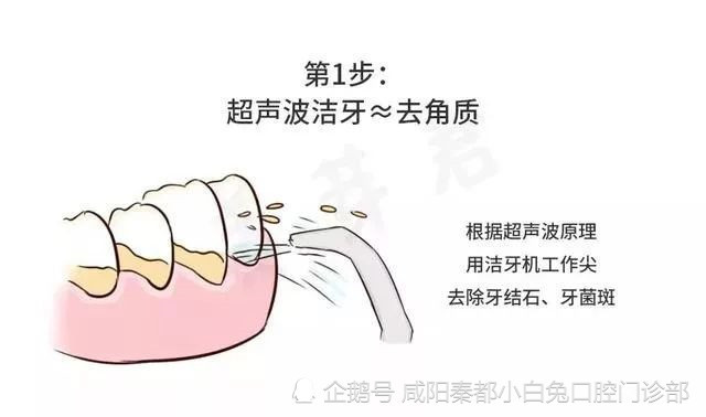所以,定期洗牙和牙周维护是十分必要的!