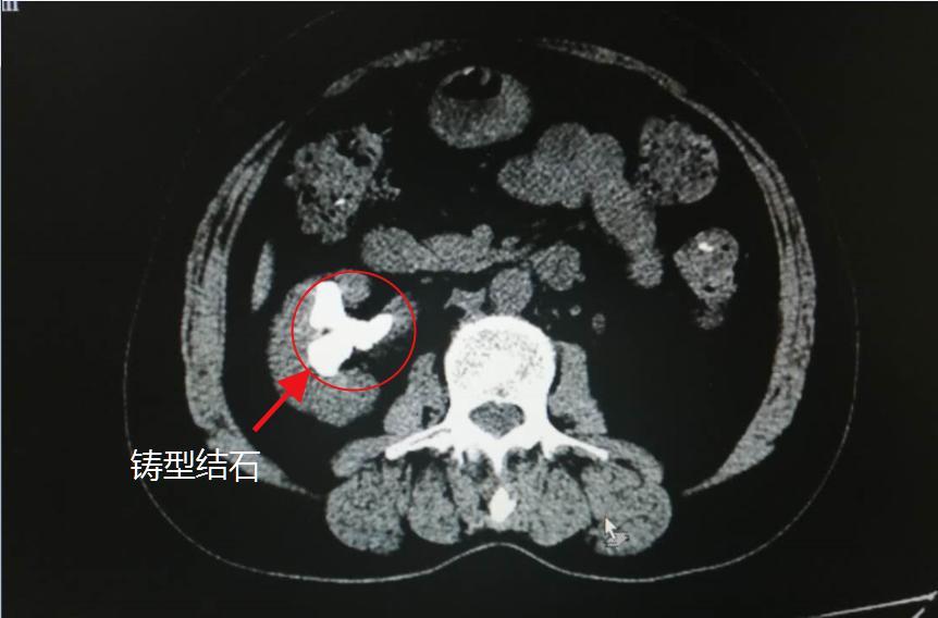 忽视结石,女子双肾竟然这样了