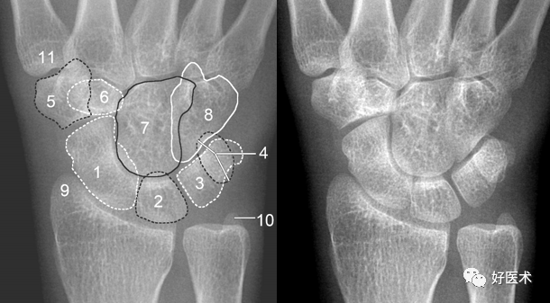 腕关节x线高清解剖图谱-最基础实用!