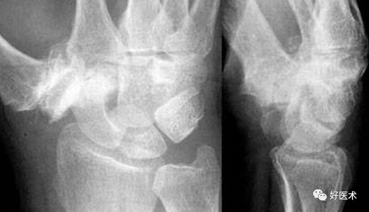 赞腕关节x线高清解剖腕骨脱位典型病例