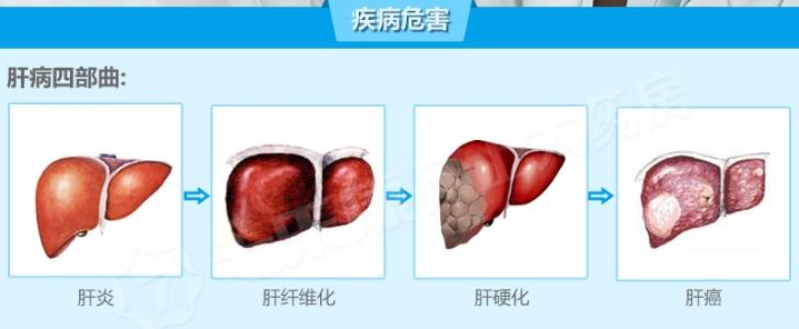 肝纤维化,能否逆转?干细胞疗法对肝纤维化的临床研究进展!