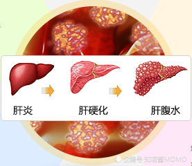 肝硬化腹水俗称肝腹水相关的知识点你要get到