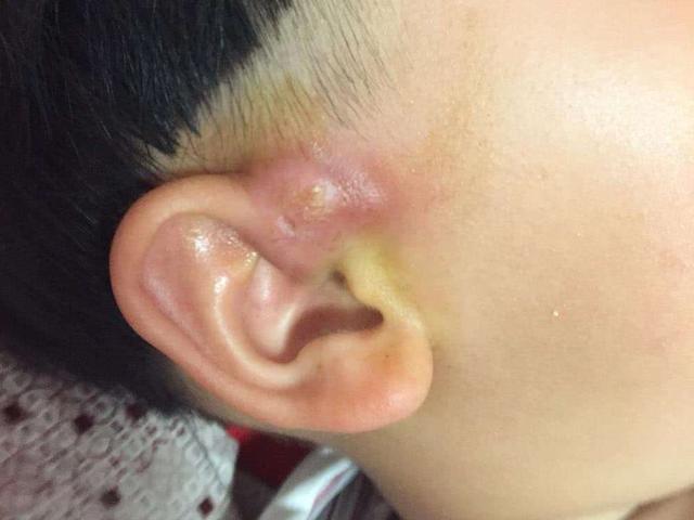 孩子耳朵上有个小孔妈妈心血来潮挤了两下医生安排手术吧