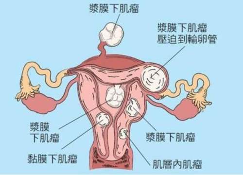 重庆弘医堂妇科医院讲解子宫肌瘤的症状表现有哪些