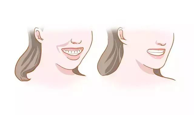 牙齿前突不仅会造成嘴巴突出,影响美观,还比较容易出现法令纹,看起来