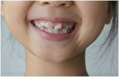 大连齿医生口腔 医生:孩子正畸一定要等到换完牙吗?
