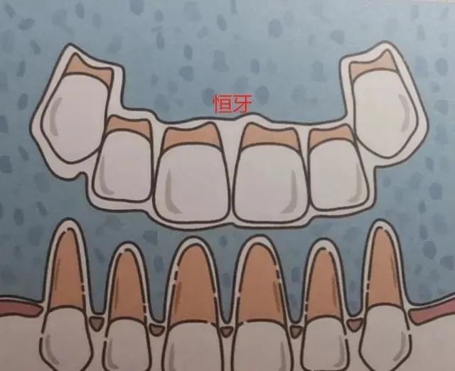 乳牙和恒牙,前牙区对比模式图,可见恒牙都是小胖子