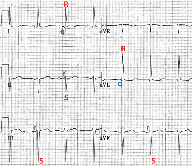 3种电轴左偏的心电图模式,你都见过吗?