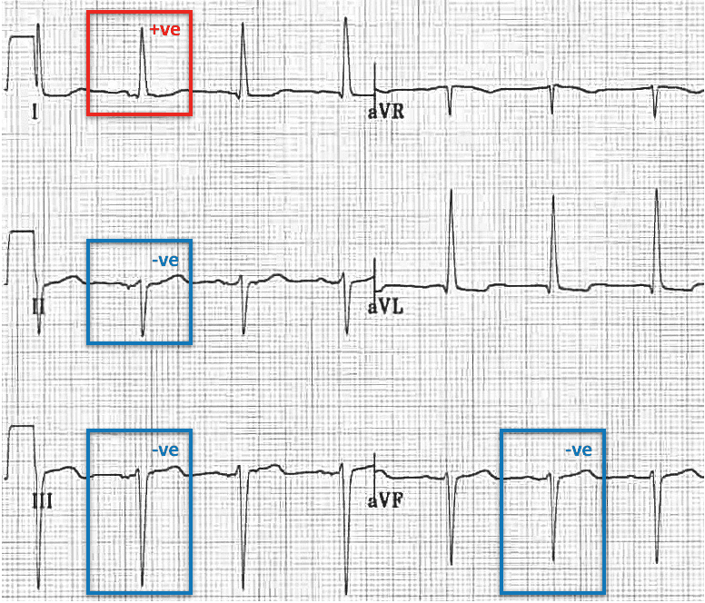 3种电轴左偏的心电图模式你都见过吗