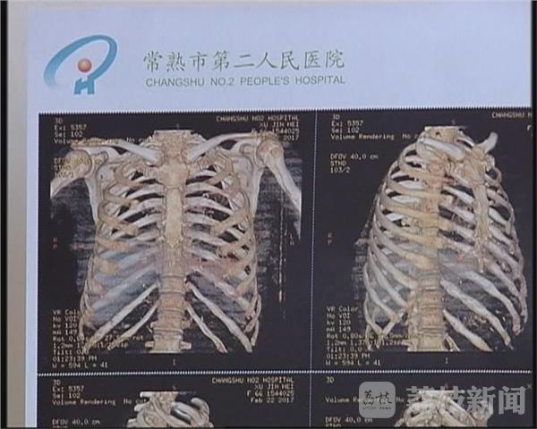 六旬老妇遭儿子暴打 11根肋骨断裂左耳膜穿孔 - 海阔山遥 - . 六旬老妇遭儿子暴打 11根肋骨断裂左耳膜穿孔 - 海阔山遥 - .