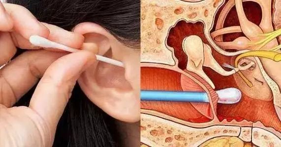外耳道炎;不恰当的挖耳还可能将外部的耳屎推至外耳道深部,加重堵塞