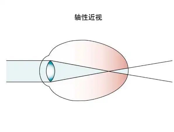 可以分为两种:轴性近视和屈光性近视,是物理改变不可能逆转.物体