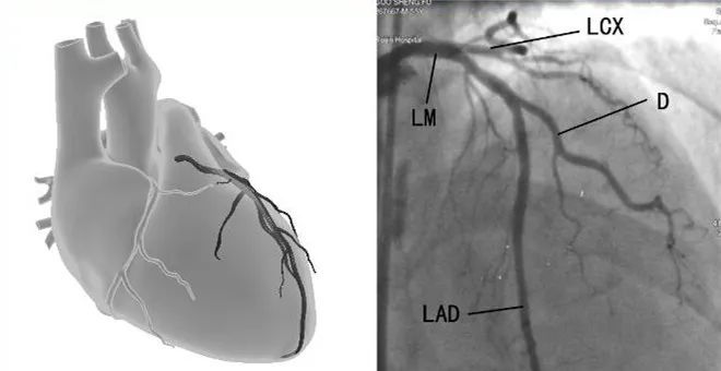 冠脉造影的常用体位你都掌握了吗