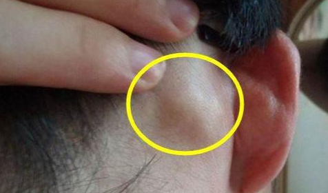 玉泉医院耳鼻喉申力主任:耳后长了个包,竟是淋巴癌的根源