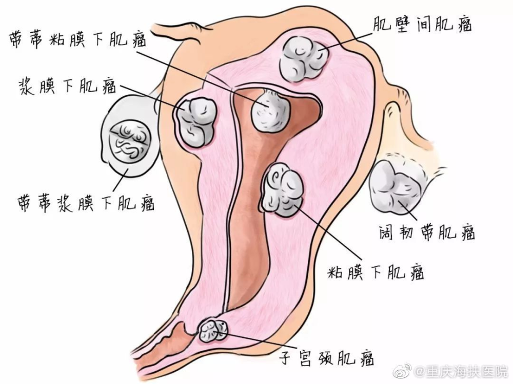 宫颈肌瘤和子宫肌瘤有什么区别