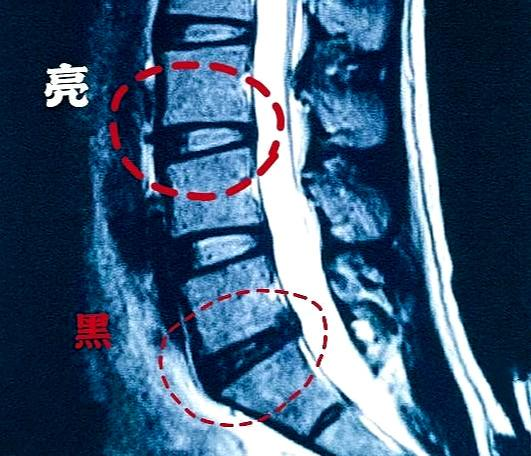 原来是因为做了核磁,看到椎间盘有退变,在核磁影像上,椎间盘的