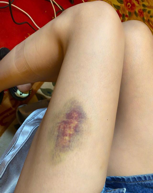 照片中,沈梦辰左侧大腿出现紫色淤青,周围一圈青色,中间紫到发红,看