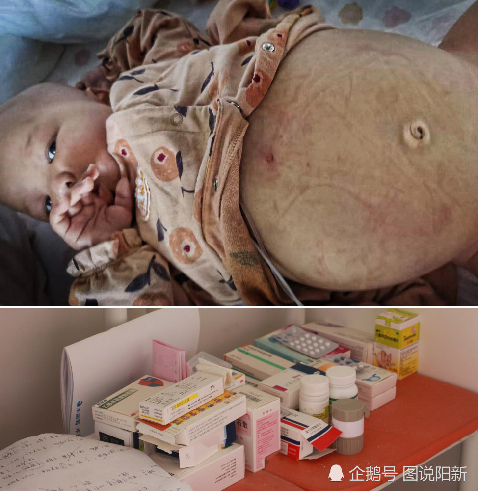 2月女婴患白血病，ICU一月签13张病危书，妈妈抑郁放弃时：宝宝笑了