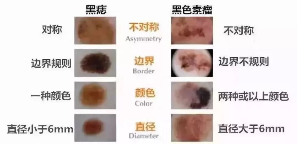 长在3个部位的"痣"易癌变!"abcde法"自测危险程度