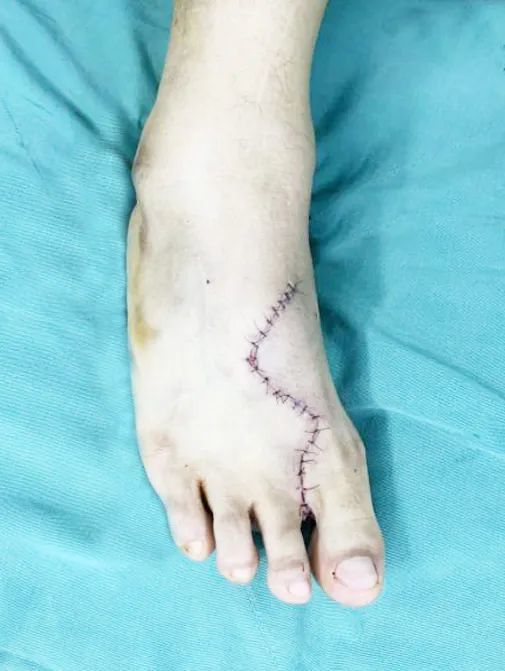 "移花接木"!延安市中医医院成功完成一例复杂拇指再造术