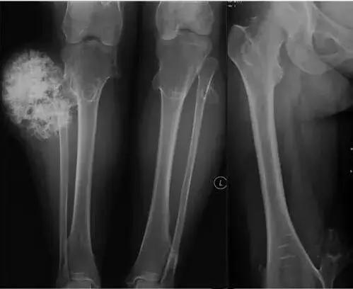 多发骨软骨瘤,可见双侧胫骨近端及远端,双侧腓骨近端,右股骨近端及