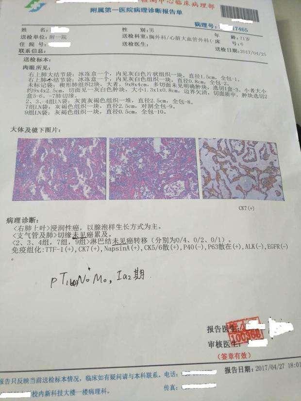 肺癌手术后看不懂病理报告单?简单学一下就能看懂,不用求医生